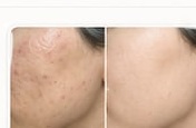 Acne scar before and after