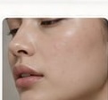 Skin rejuvenation treatment